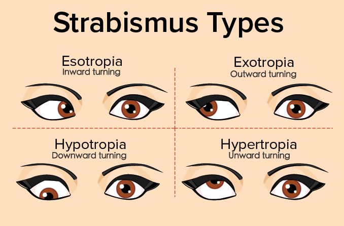 strabismus-types-678x446